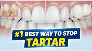#1 Absolute Best Way to Stop Tartar FAST!Dentists Hate How Simple This Tartar Trick Is!Remove Tarta