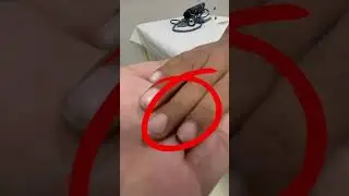 Clubbing of Nails #clubbing #nails #drrizwangohar