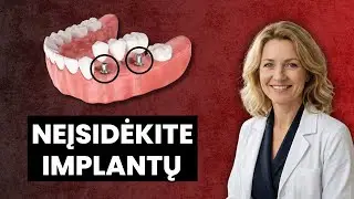 Nedarykite implanto, kol to nesužinosite! Odontologai neatskleidžia tikrojo paslėpto pavojaus