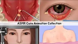 ASMR Care Animation, Eye Stone Removal, Conjunctivitis, Salivary Gland Stones, blackheads, Back Acne