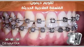 تقويم ديمون. الفلسفة العلاجية الحديثة. Damon system braces. The new orthodontic philosophy.