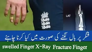 cricket ball hit on finger. Finger fracture.Swellen finger treatment.