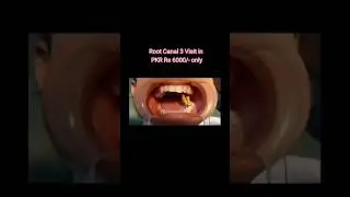Rashid Dental Clinic #rootcanal #rct #dentist #polishing #filling #crown #bridge#scaling#extraction