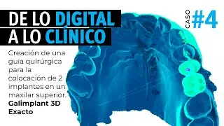 De lo DIGITAL a lo CLÍNICO. Creación de una guía quirúrgica con Galimplant 3D Exacto. #CC4