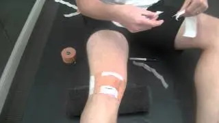 Patellar taping for patellofemoral pain and infra-patellar fat pad irritation