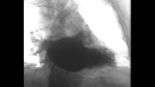 Rotational angiography mp