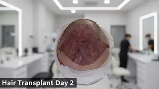 Hair Transplant Day 2 &ndash; Washing, Healing & What to Expect