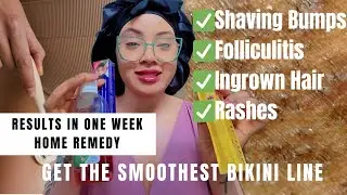 How to Treat Ingrown Hair, Rashes & Razor Bumps On the Genital Area  in 1 Week @mayLuxeskincare 