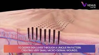 Transform Your Skin with VENUS Viva&trade; MD | Skin Resurfacing & Rejuvenation Treatments