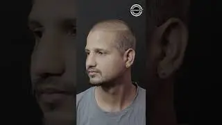 9 Months Transformation after DMC-Golden Touch &reg; Hair Transplant | Hair Transplant Clinic