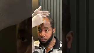 Afro hair transplant l Afro hair transplant in Turkey  #afrohairtransplant  #afrohair