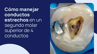 Cómo manejar conductos estrechos en un segundo molar superior de 4 conductos
