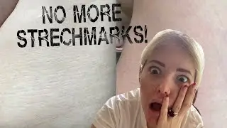 Я ВЫЛЕЧИЛА СВОИ РАСТЯЖКИ!! МИКРОНИДЛИНГ СВОИМИ РУКАМИ!