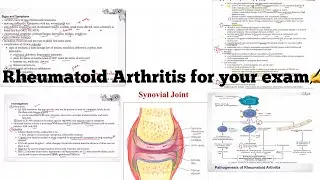 Rheumatoid arthritis for your exam -make it easy