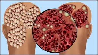 ASMR Treatment Lice and Scabies on the Head  Satisfying Removal Fungal Scalp