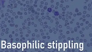 Red cells: Basophilic stippling