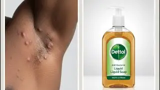 Get rid of razor bumps using dettol liquid soap