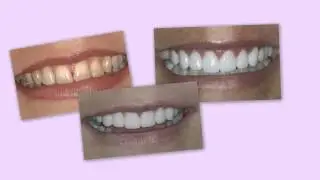 Temporary Veneers as a 