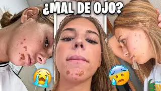 QUE ME PASA EN LA CARA? MAL DE OJO O IMPETIGO? / El mundo de Indy