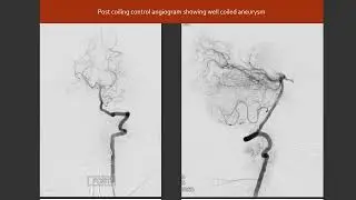 Balloon assisted basilar tip aneurysm coiling