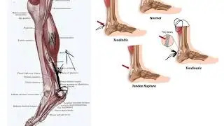 Achilles Tendon Stretching (Don't Do It!)
