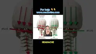 Natural Headache treatment Miami | Natural headache doctor Miami | Upper cervical chiropractic Miami