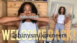 MY NEW SMILE! @Shinysmileveneers HONEST REVIEW/REVEAL!!!