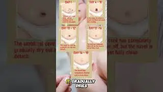 Baby Belly Button: How the Umbilical Cord Stump Heals & Falls Off!
