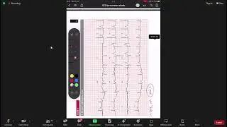 LKMI EKG