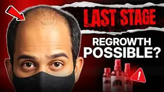 Doctor Approved Hair Fall Solution | Complete Hair Regrowth Guide