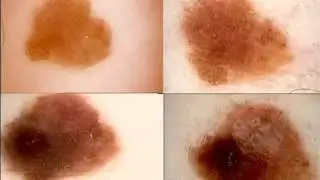 Follow-up with digital dermatoscopy by Dr. Harald Kittler 2/3