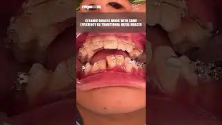 Ceramic Dental Braces Fixing Process - #dentalbraces #braces #invisiblebraces #orthodontictreatment