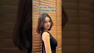 Контур лица и Ринопластика в клинике &laquo;Гирин&raquo;. #контурлица #ринопластика #клиника #Гирин #пластика