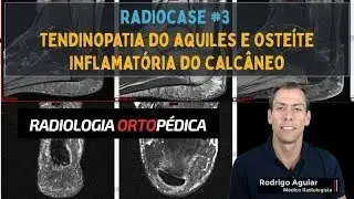 Tendinopatia do Aquiles e Entesopatia Inflamatória do Calcâneo