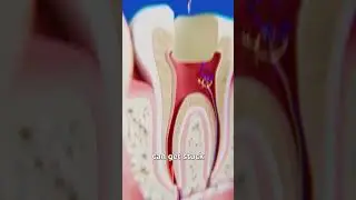 When root canal tools break off😨#dental #dentistry #dentalhealth #tooth #implant #rct #yt #toothless