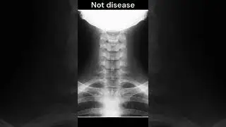 This Difference Has Nothing to do with Disease