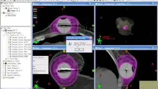 Contura Patient B -Using Brachyvision to Treatment Plan a Challenging Case