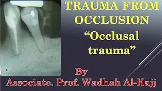 53- Trauma from occlusion ‫‬- Dr Wadhah Periodontology lectures.د/ وضاح الحاج‬‬‬‬‬‬‬‬‬‬‬‬‬‬‬‬‬‬‬‬‬