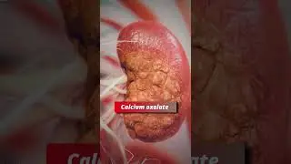 Beer Kidney Stones ke Liye Useful Hai Ya Harmful? | Dr. Sumit Bansal Explains