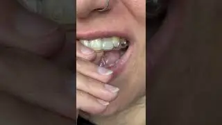 For missing tooth!