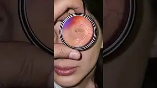 Macular star.
