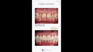 Fatete dentare inainte si dupa!