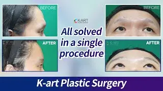 Brow Bone Rasping,Eyehole Bone Rasping, Hairline Lowering, Volume Surgery, Glabellar Wrinkle etc.