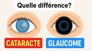 Glaucome ou Cataracte : Quelle Diff&eacute;rence ?