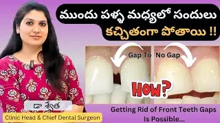 3 Best Teeth Gap Treatment | Diastema | Gap Teeth Filling | Palla Sandulu in Telugu | Dr Swetha