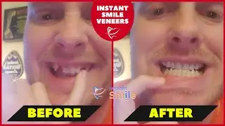 Jonathon Review | Instant Smile Veneers Customer Review 2025