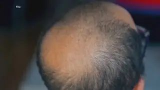 Recent medical studies find new treatments to improve hair growth