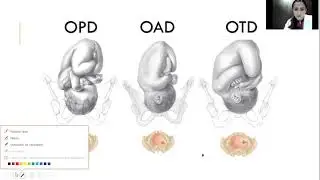 MODULO DE GINECOOBSTETRICIA: MECANISMOS DEL TRABAJO DE PARTO