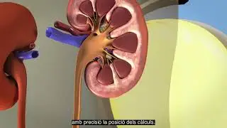 Shockwave Lithotripsy Explained: Non-Surgical Kidney Stone Treatment | Urocat Urology