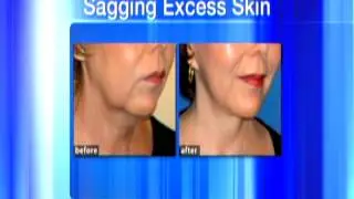 What are the 3 signs of aging? How do you know if a face lift is the right option?